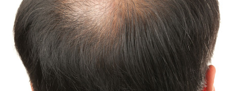 Alopecie